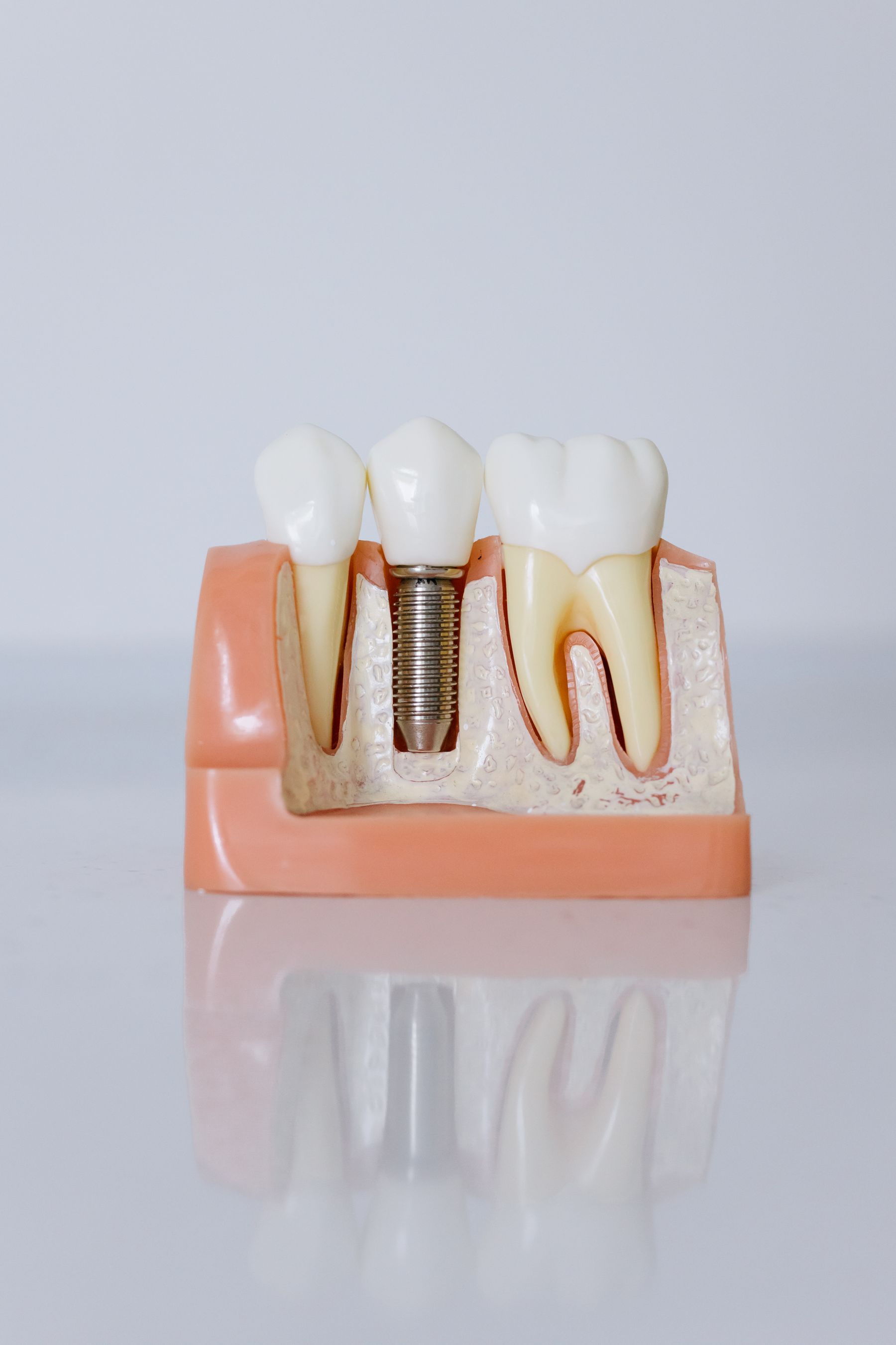 Educational model showing an implant and natural tooth roots